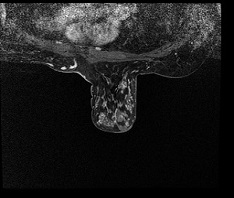 Breast Stereotactic